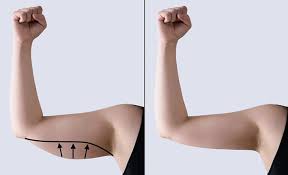 Liposuction