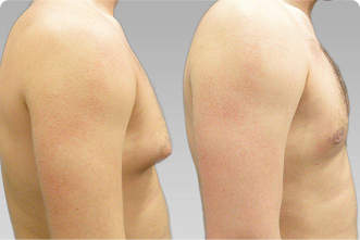 Gynecomastia