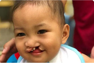 Cleft Lip & Cleft Palate