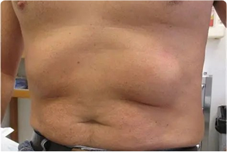 Incisional Hernias