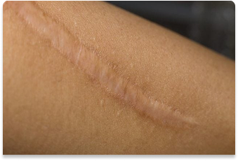 Hypertrophic Scars & Keloids