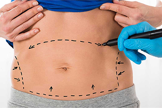 Abdominoplasty (Tummy Tuck)